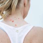 acne on back of the neck