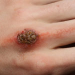 best solutions to get rid of scabs naturally