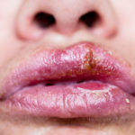 home remedies to cure lip infection