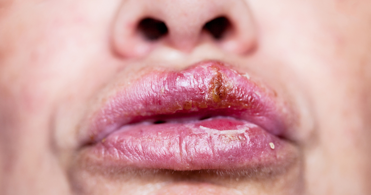 lip-infection-bacterial-infections-on-lips-learn-all-causes-and-treatment