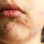 what causes rashes around the mouth