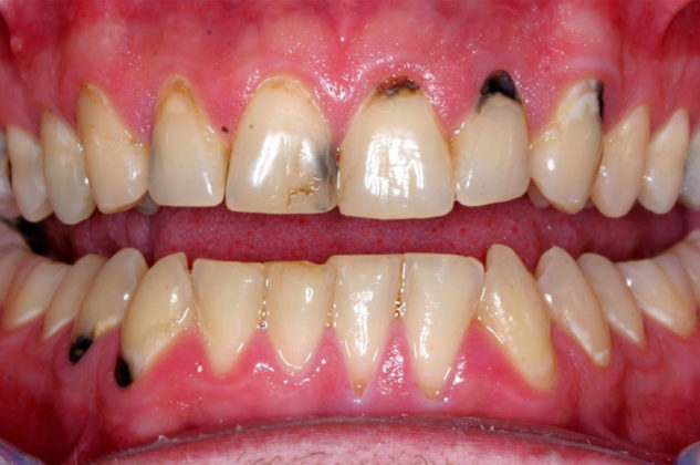 pathological fear of gums