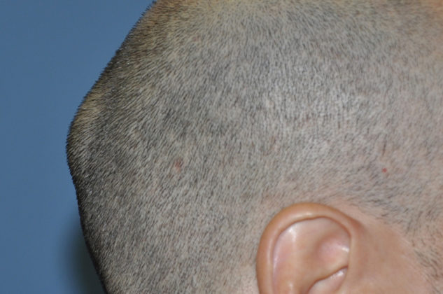 Bony Bump On Back Of Skull Left Side Painful