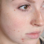 effective ways to remove acne scars