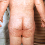 heat rash on buttocks causes and remedies