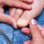 home remedies for bruised toenails