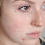 how to get rid of acne scars naturally