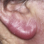 symptoms of swollen ear lobe