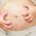 ways to get rid of pregnancy stretch marks