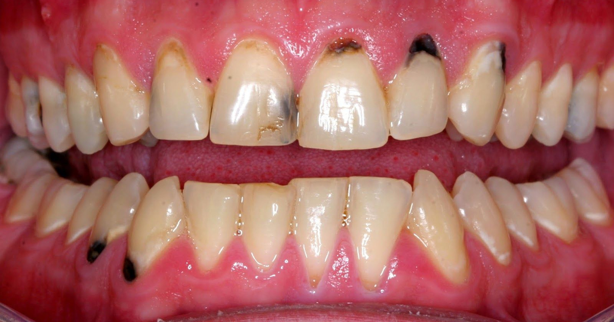 Black Spot On Gums Near Tooth Learn What Causes Dark Spots On Gums