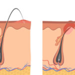 what causes ingrown hair