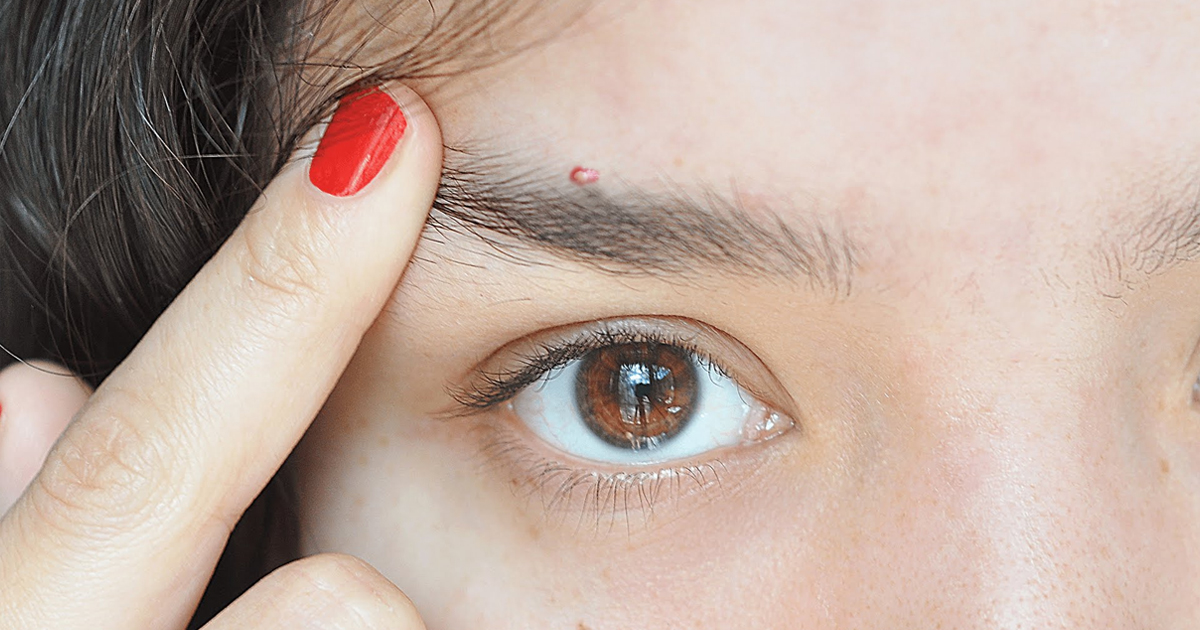 Pimple On Eyebrow Learn How To Get Rid Of Acne Between Eyebrows