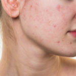 what is acne scars