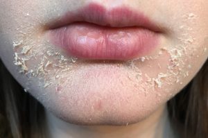 Why It Is Dry Skin Around Mouth? Learn Causes And Cure Naturally