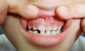 What Are Gum Boils And Causes How Can They Be Treated?